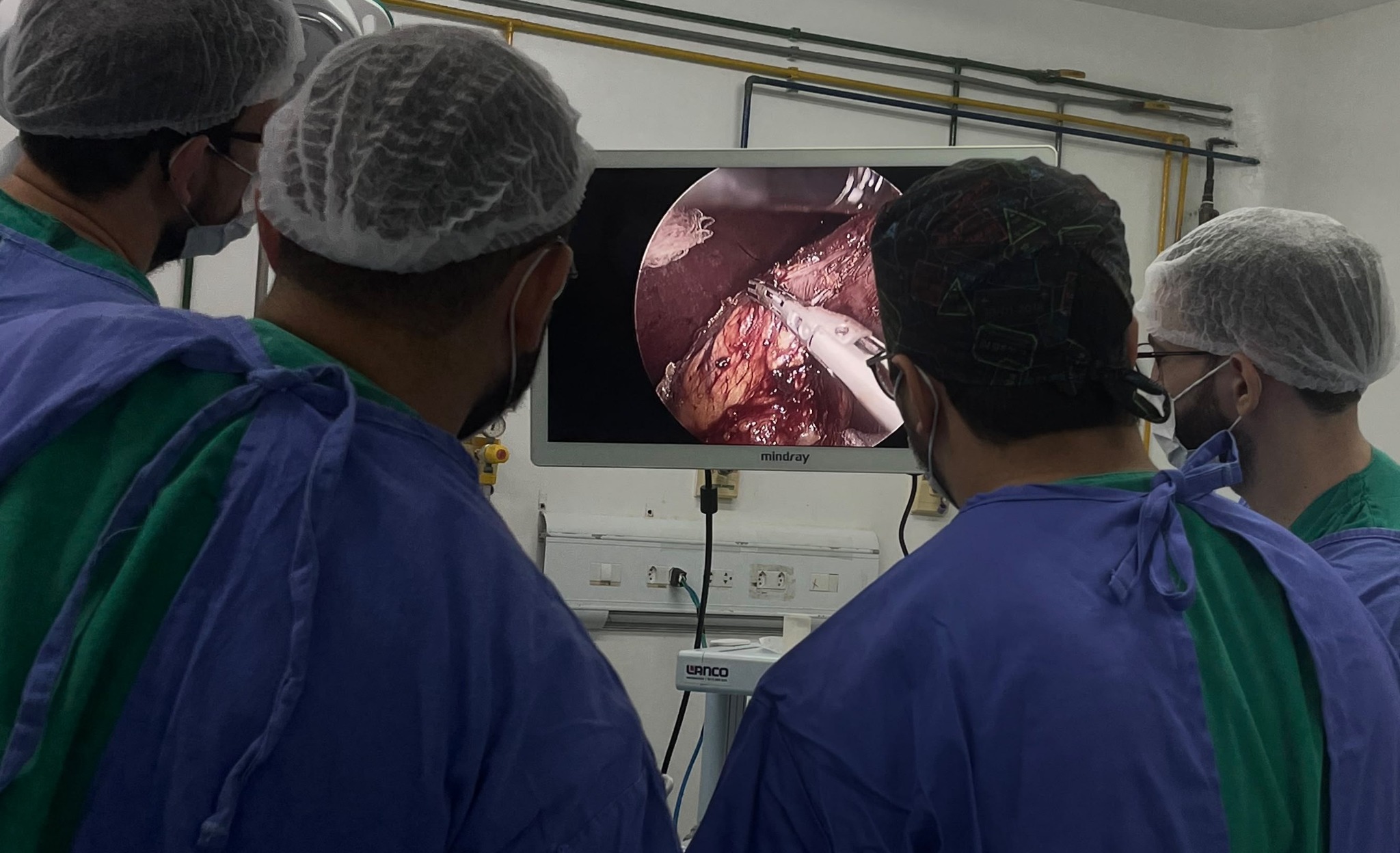 Equipe cirúrgica realizando gastrectomia parcial minimamente invasiva por videolaparoscopia no Recife
