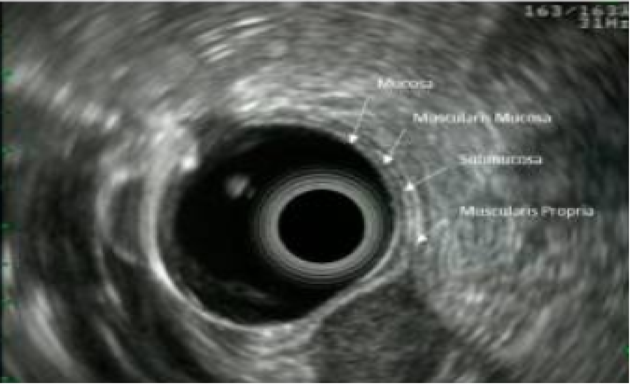 Imagem de ecoendoscopia mostrando as camadas da parede gastrointestinal e uma lesão subepitelial