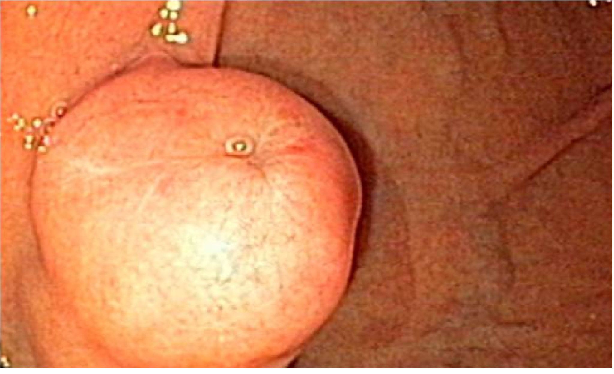 Endoscopia digestiva alta mostrando elevação subepitelial arredondada na parede do estômago